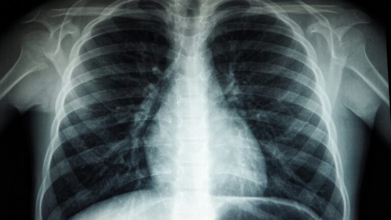A chest X-ray showing the rib cage, lungs, and heart structure