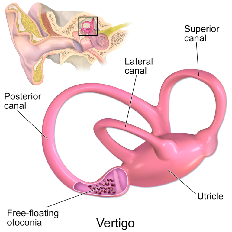 Diagram of the inner ear semicircular canals showing free-floating otoconia that cause BPPV vertigo